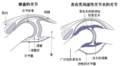 F(yng)(qing)ֱt(y)ԺL(fng)񲡰l(f)ʾD.jpg