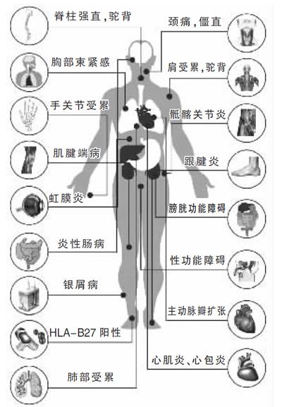 貴陽強(qiáng)直醫(yī)院強(qiáng)直性脊柱炎的危害可累及全身.jpg